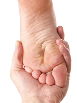Verrue de la main : symptômes, causes et traitements